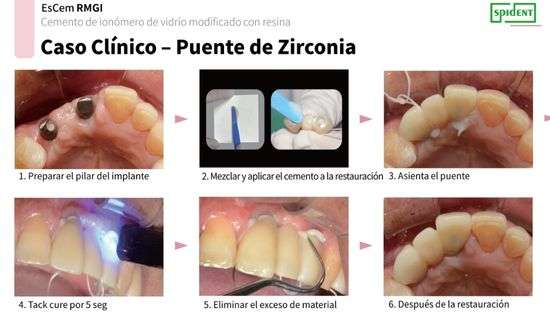 Cemento dual EsCem RMGI - Spident 4 Cemento dual EsCem RMGI - Spident - Imagen 4