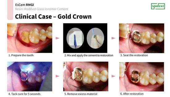 Cemento dual EsCem RMGI - Spident 2 Cemento dual EsCem RMGI - Spident - Imagen 2