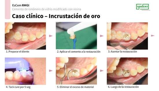 Cemento dual EsCem RMGI - Spident 3 Cemento dual EsCem RMGI - Spident - Imagen 3