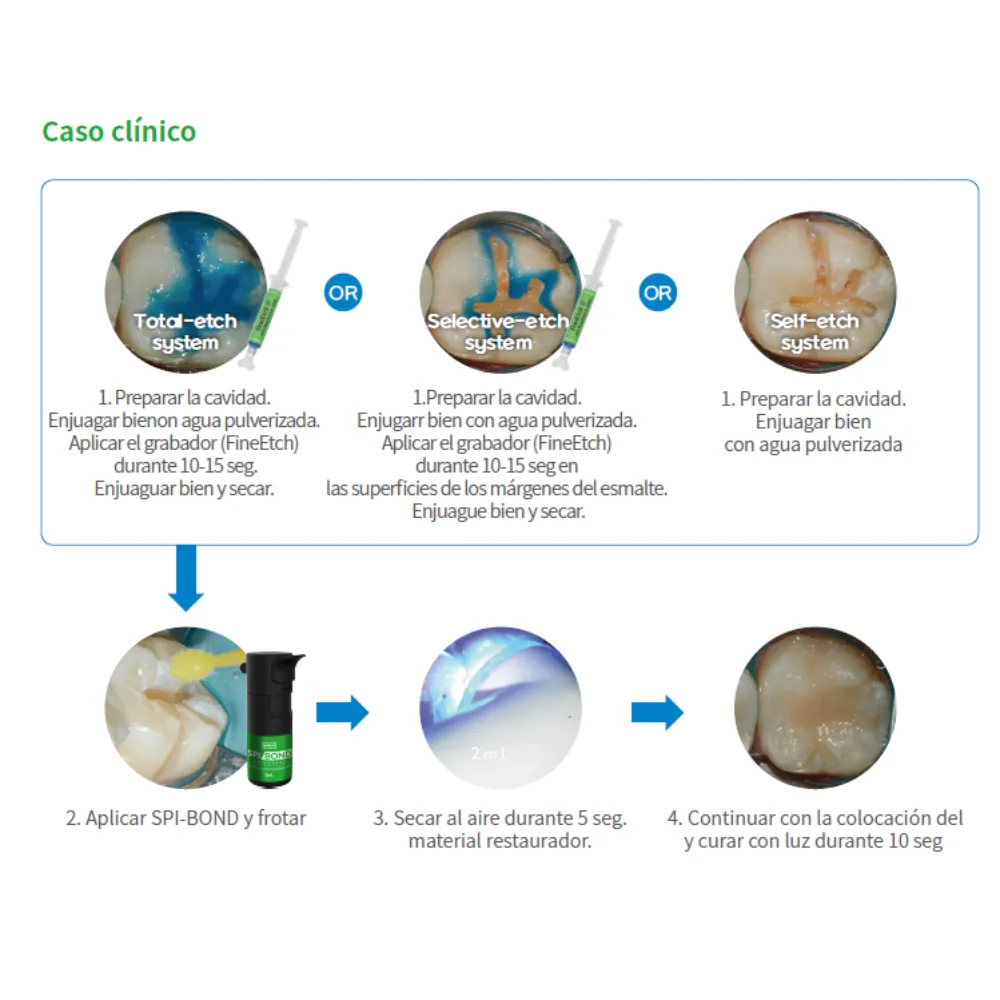 Adhesivo Universal Dental SPIBOND | Spident 4 Adhesivo Universal Dental SPIBOND | Spident - Imagen 4